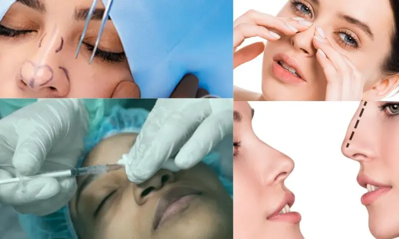 Rinoplasti - تجميل الانف Nedir?