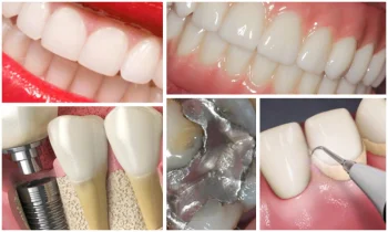 Dental İmplantlar Nasıl Uygulanır