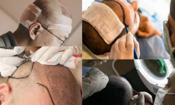 Türkiye'de Saç Ekimi - Hair Transplant in Turkey Yapılır Mı?