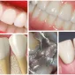 Dental İmplantlar Nasıl Uygulanır